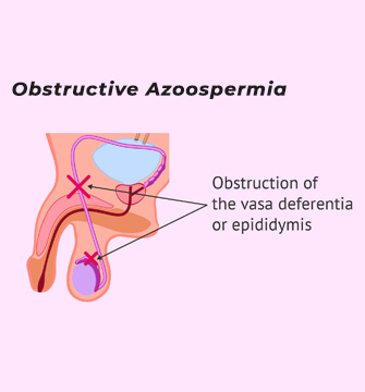 Obstructive-azoospermia